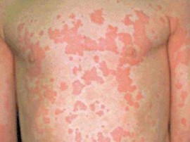 Кожная аллергия на холод: как узнать болезнь по симптомам и избавиться от нее?