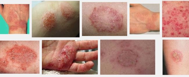 Экзема — острое или хроническое незаразное воспалительное заболевание кожи, характеризующееся разнообразной сыпью, чувством жжения, зудом и склонностью к рецидивам