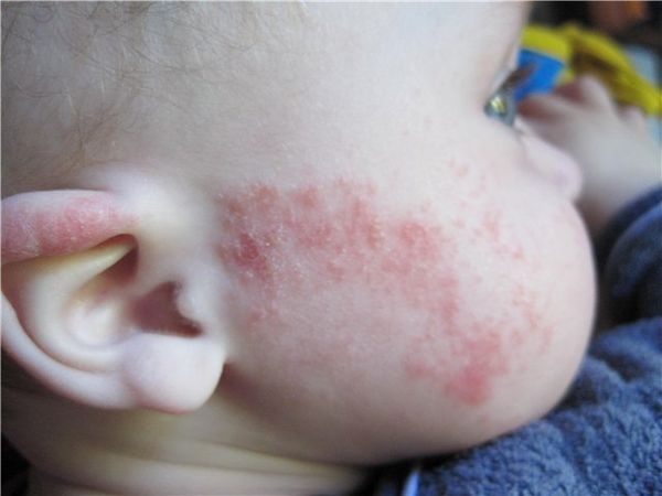 Проявление аллергической экземы у ребенка.