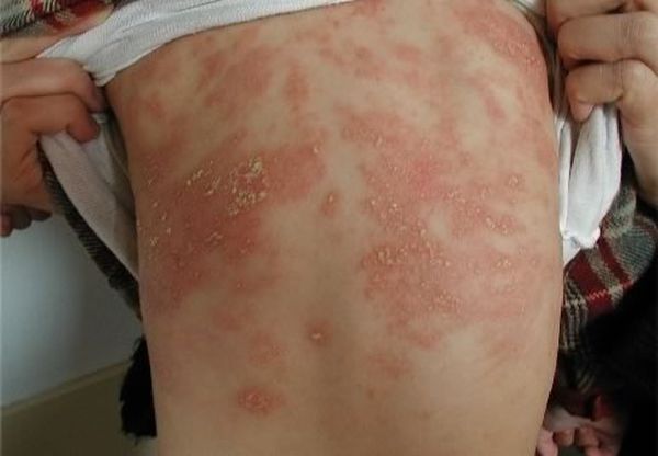 Проявление аллергической экземы на животе у ребенка.
