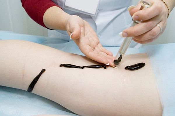 Прежние пораженные экземой клетки кожи погибают при гирудотерапии.
