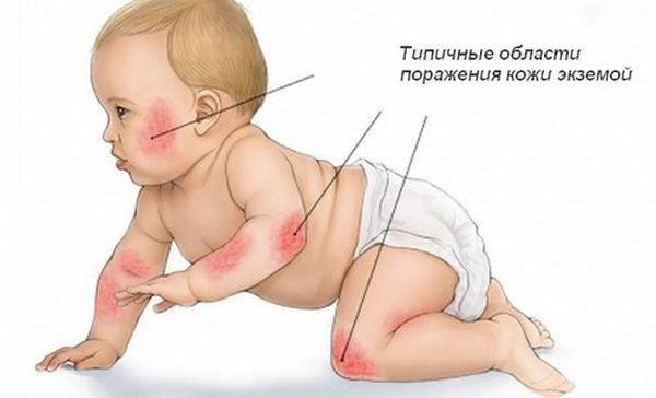 Области тела ребенка, которые чаще всего поражаются экземой.