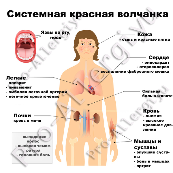 Симптомы системной красной волчанки (СКВ)