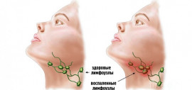 Распространенные проблемы с лимфатическими узлами под челюстью и методы из лечения